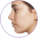 Micro abrasion for acne scars